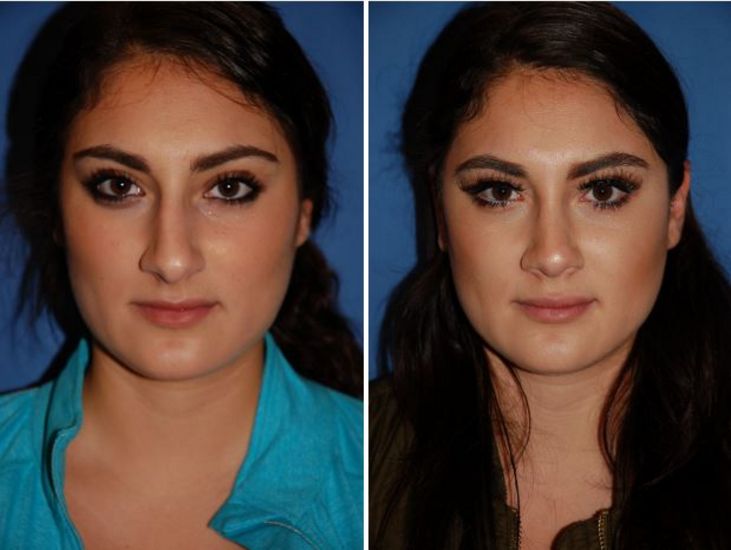 seattle rhinoplasty